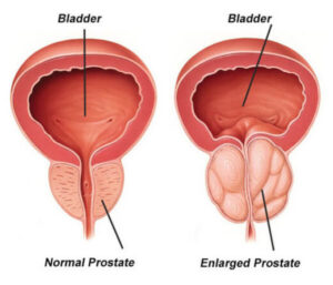 benign prostatic hyperplasia bph 520x445