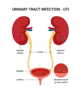 urinary tract infection