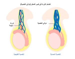 varicocele and infertility treatment uae ar