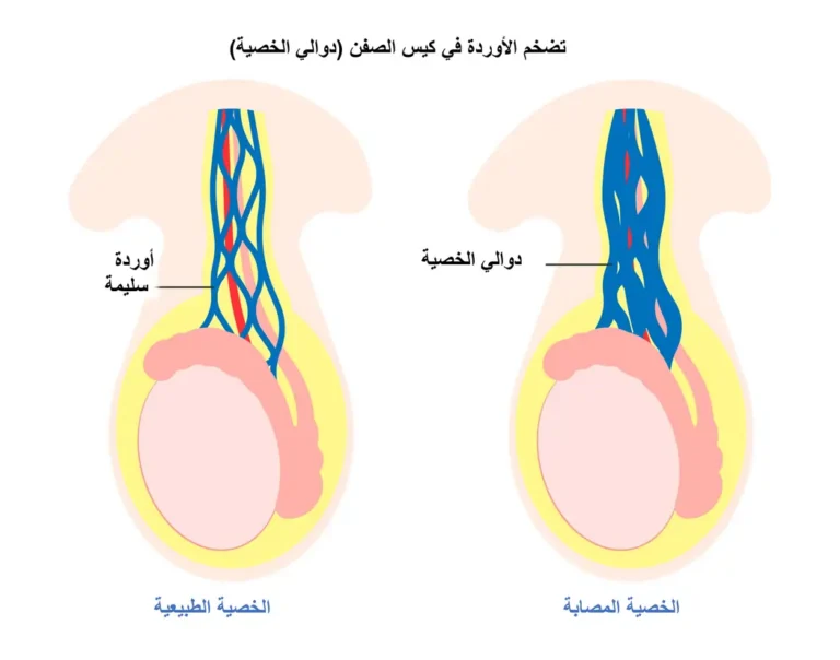 varicocele and infertility treatment uae ar
